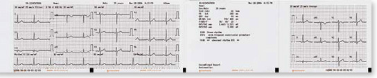 Paper EKG Thermal Red Grid Z-Fold fits ecg-9100, ecg-9110, ecg-9130K1350A Generic for Nihon-Kohden (1/PK 10PK/CS) by Precision Charts  ID PA9100Z